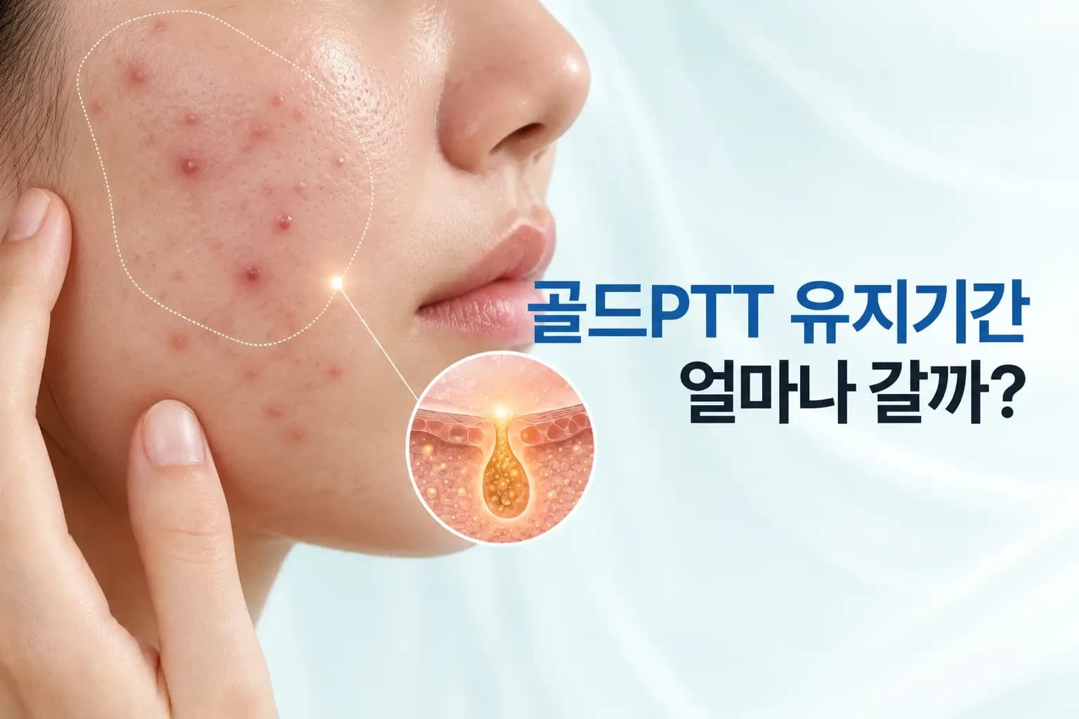 볼 피부와 금 입자가 피지선 주변에 모여 열을 내는 확대 인셋을 조합한 골드PTT 유지기간 썸네일