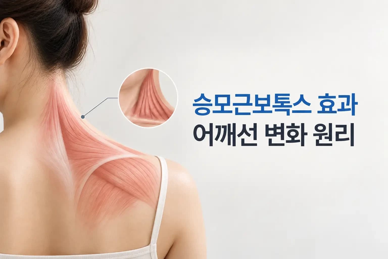 여성의 목과 어깨 뒷모습에 상부 승모근 윤곽 점선과 주사기를 조합한 승모근보톡스 효과 썸네일