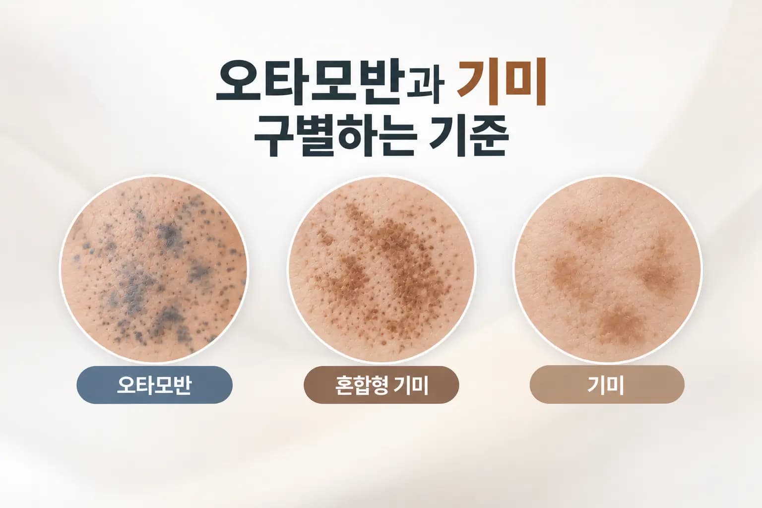 볼 피부의 푸르스름한 점상 색소와 갈색으로 번진 얼룩을 나란히 배치한 오타모반 기미 차이 썸네일