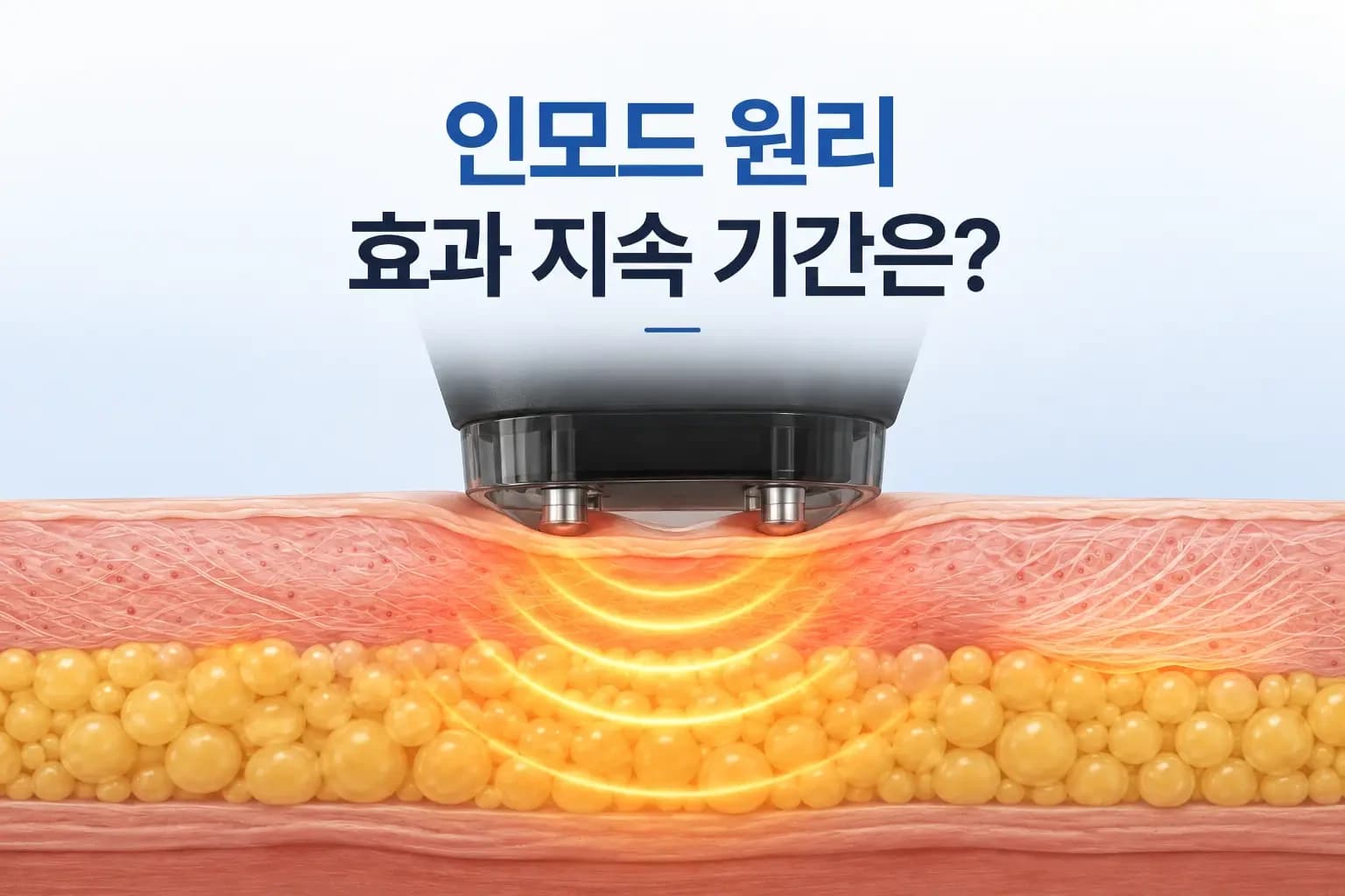 인모드 핸드피스와 진피·지방층에 고주파 열이 전달되는 과정을 조합한 인모드 원리 썸네일