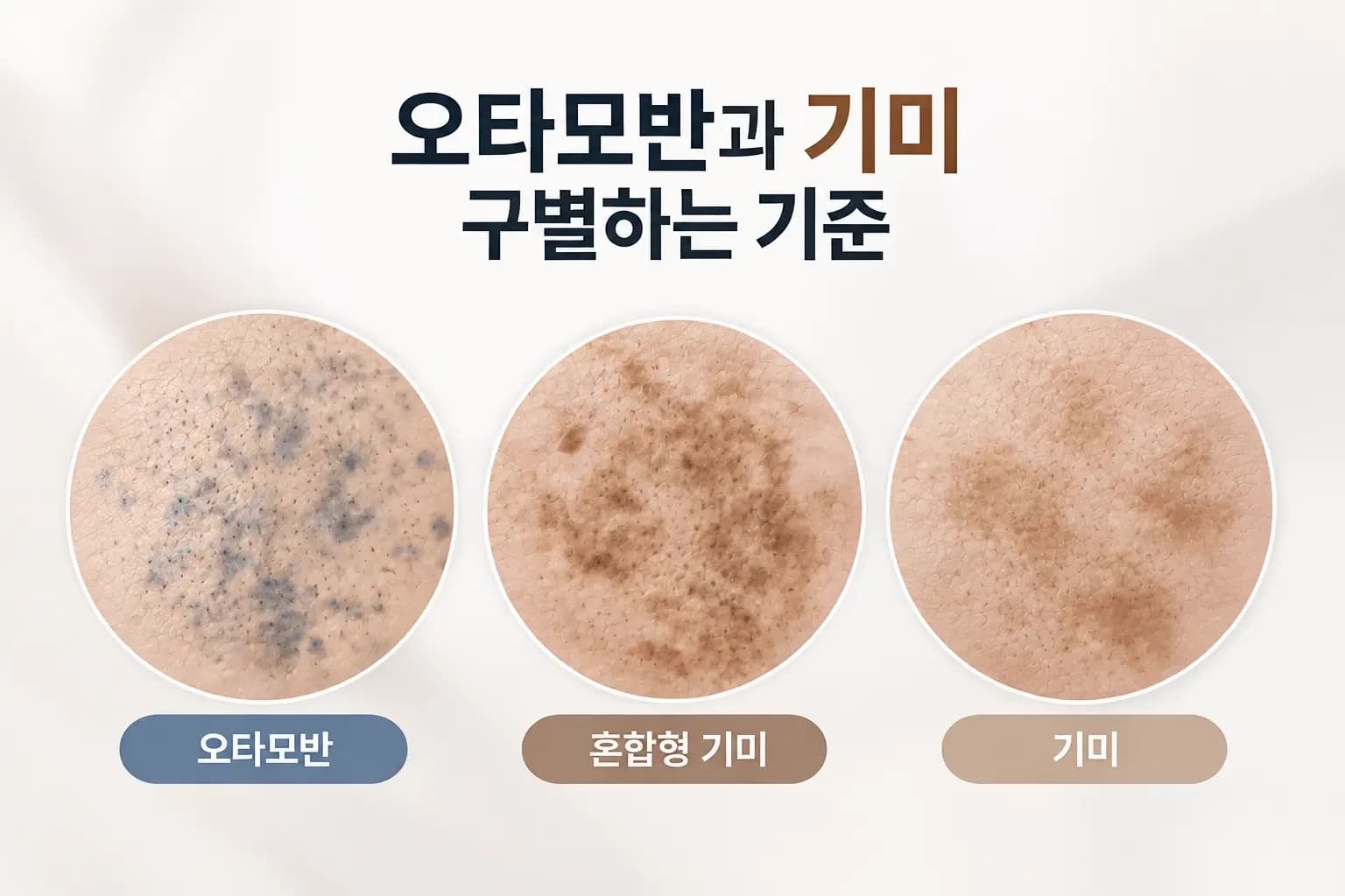 볼 피부의 푸르스름한 점상 색소와 갈색으로 번진 얼룩을 나란히 배치한 오타모반 기미 차이 썸네일