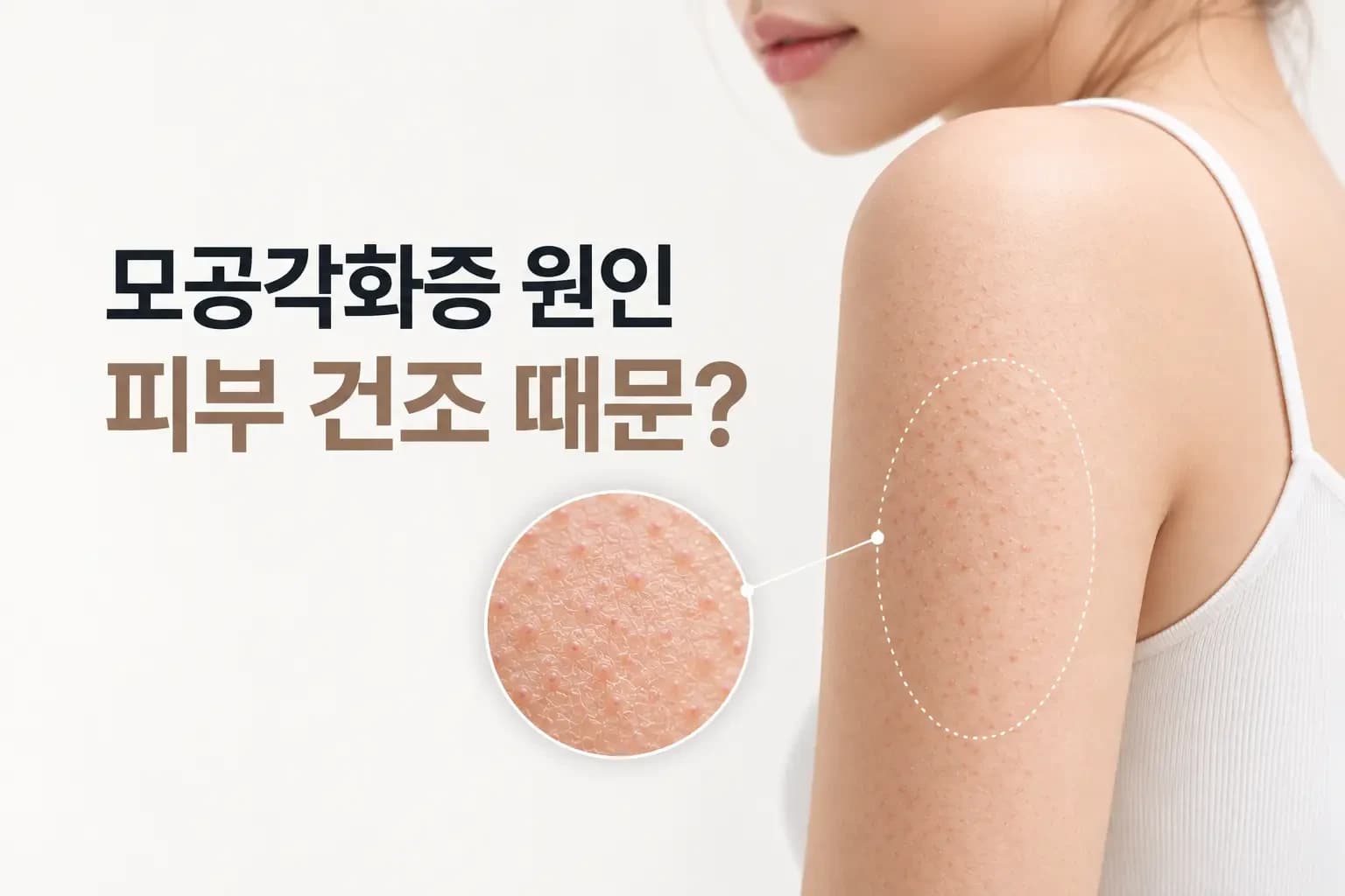 건조한 위팔 피부의 작은 돌기와 모낭 입구 각질 마개 확대 인셋을 담은 모공각화증 원인 썸네일